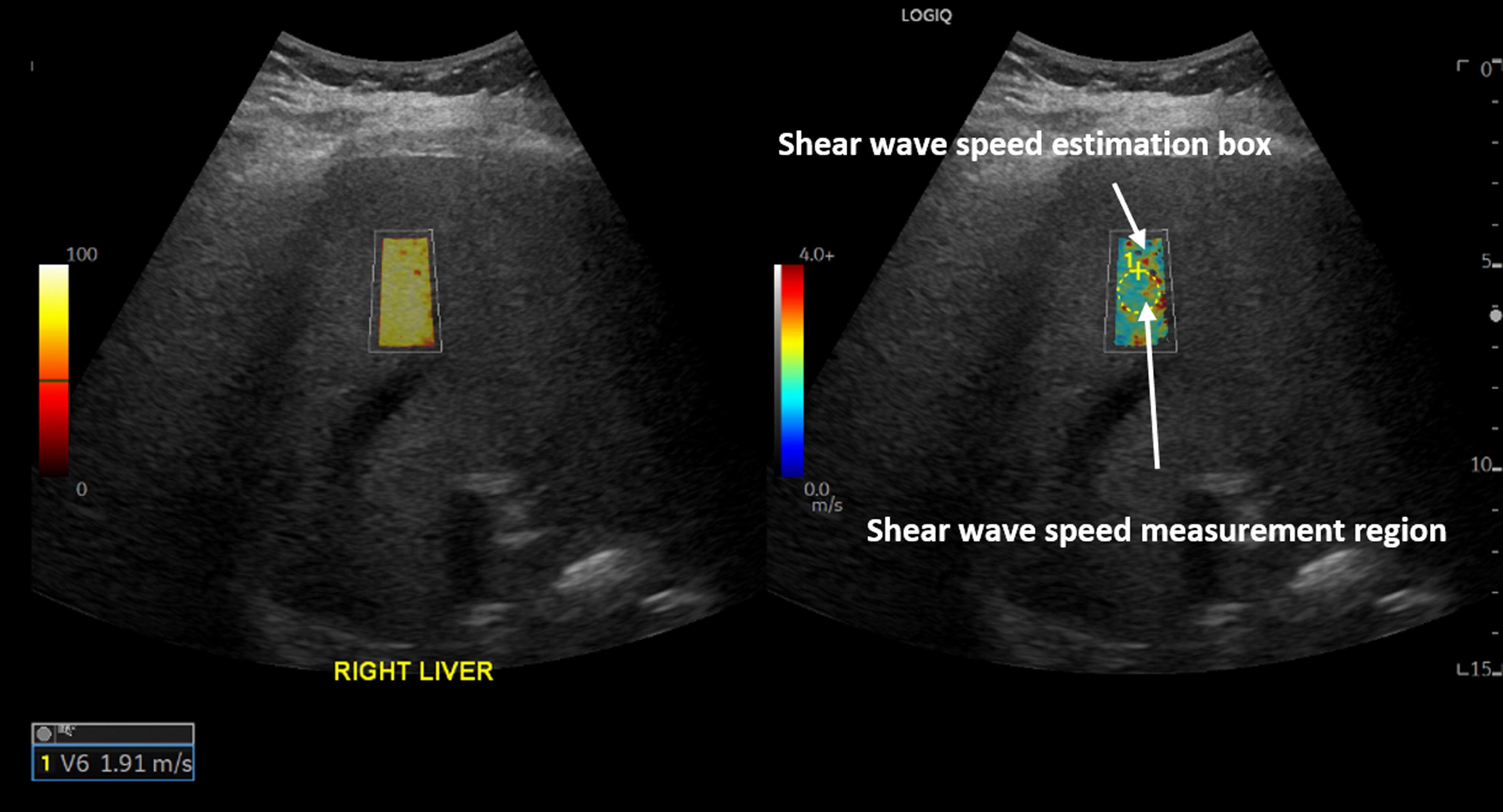 New Ultrasound Study Shows Increased Liver Stiffness 10 Months After COVID-19 Infection New Ultrasound Study Shows Increased Liver Stiffness 10 Months After COVID-19 Infection