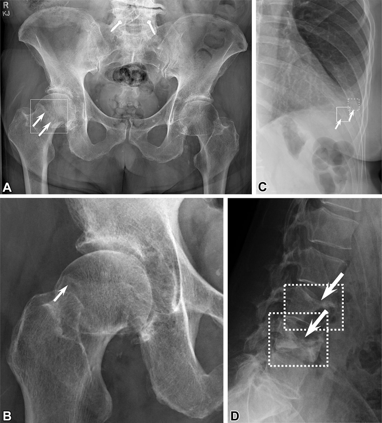 AI Software for Fracture Detection Gets FDA Clearance