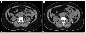 Study: Photon Counting CT Reduces Radiation Exposure by 44 Percent for Kidney Stone Detection