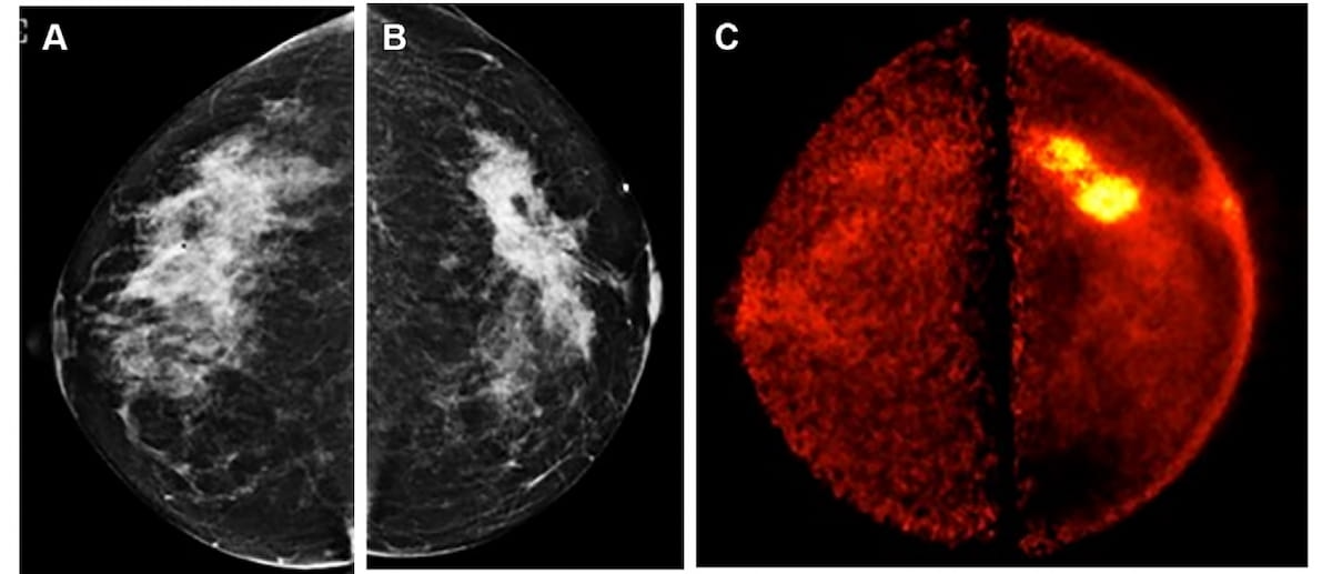 Pem Scan Can Positron Emission Mammography Have an Impact in Diagnosing Invasive ...