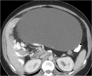 ACCESORY ANULAR PANCREAS CAUSING GASTRIC OUTLET OBSTRUCTION
