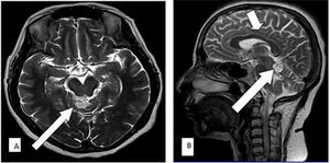 Quadrigeminal Plate Cistern Lipoma