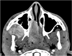 Juvenile Angiofibroma
