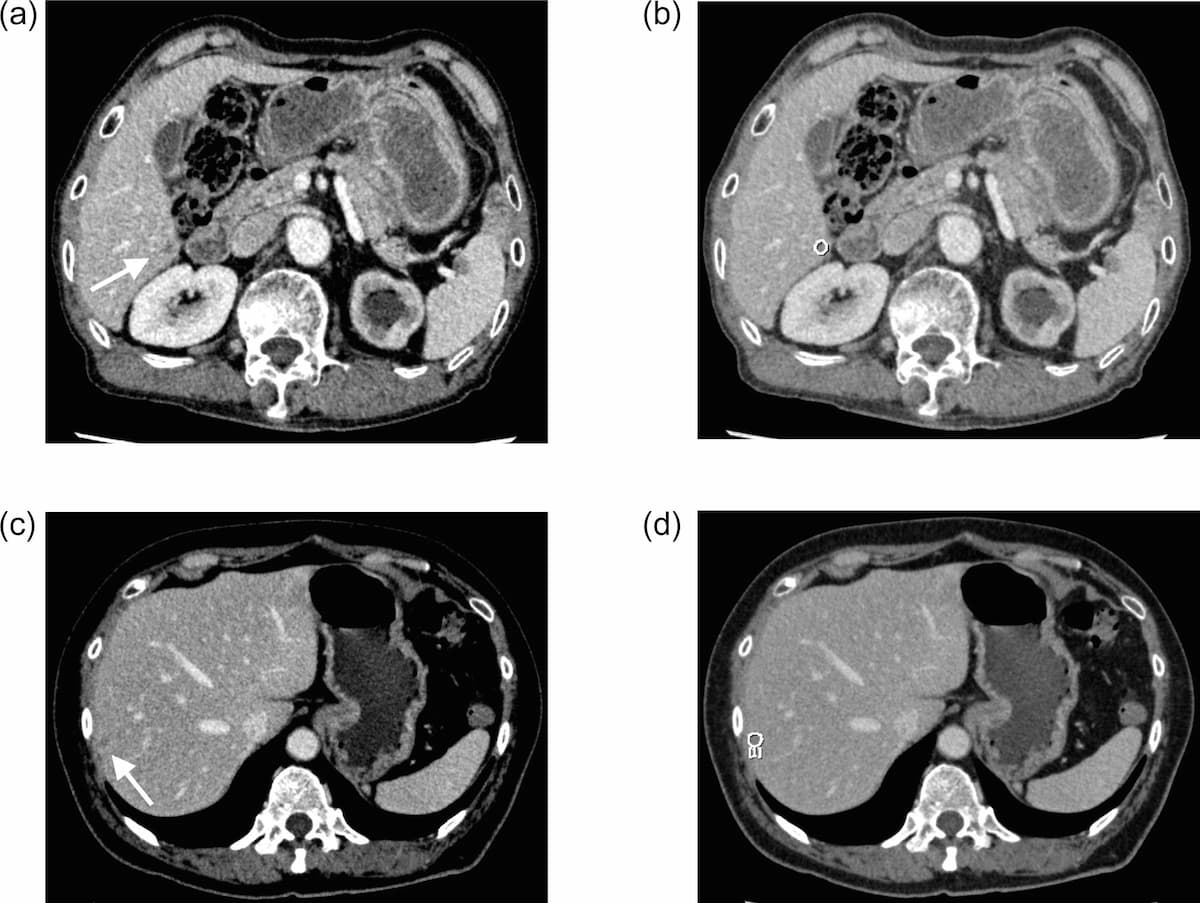 Study Looks at Capability of AI for Detecting Overlooked Liver Metastases on CECT