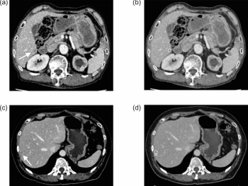 Study Looks at Capability of AI for Detecting Overlooked Liver Metastases on CECT