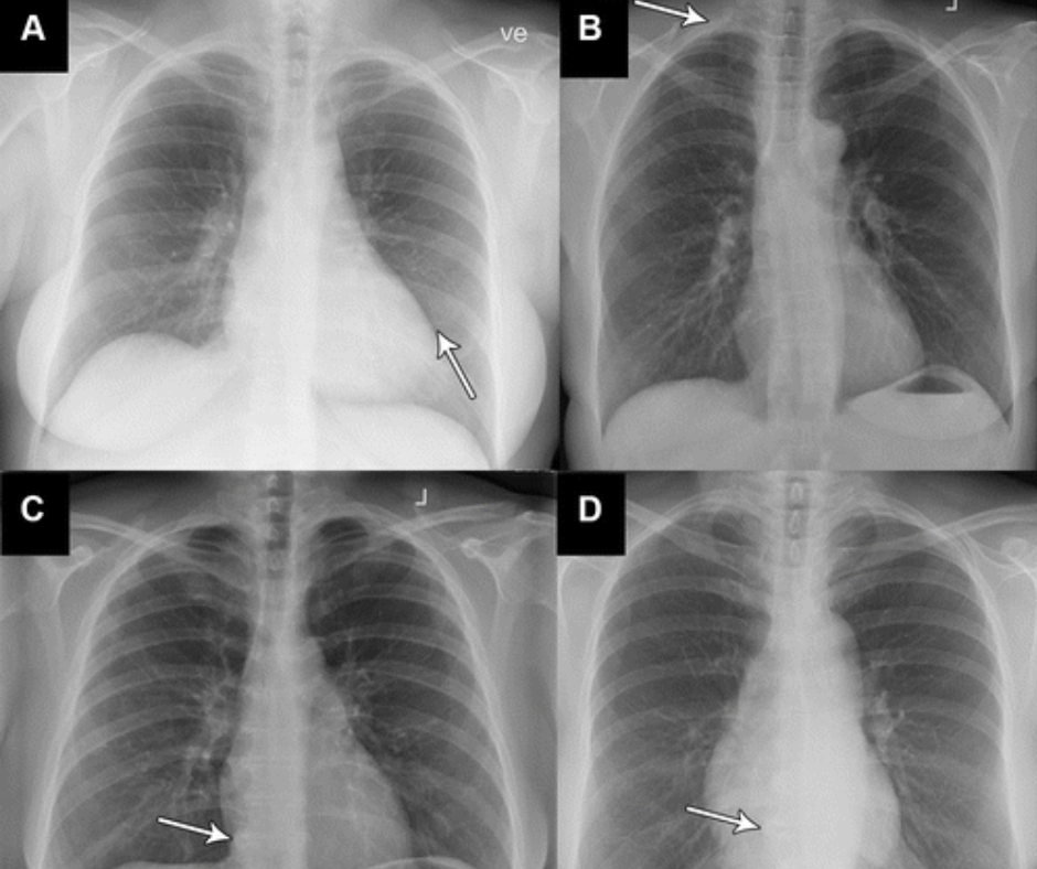 Autonomous AI Shows Nearly 27 Percent Higher Sensitivity than Radiology Reports for Abnormal Chest X-Rays
