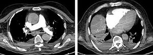 Sudden Cardiac Arrest During CT Scan