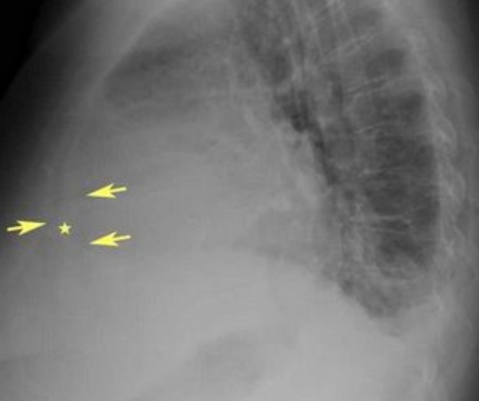 Image IQ Quiz: Shortness of Breath and Chest Fullness in a 20-Year-Old Recovering from a Virus