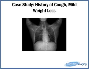 History of Cough, Mild Weight Loss