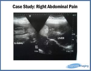 Right Abdominal Pain