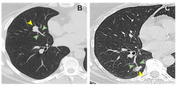 CT Study Reveals Key Indicators for Angiolymphatic Invasion in Non-Small Cell Lung Cancer