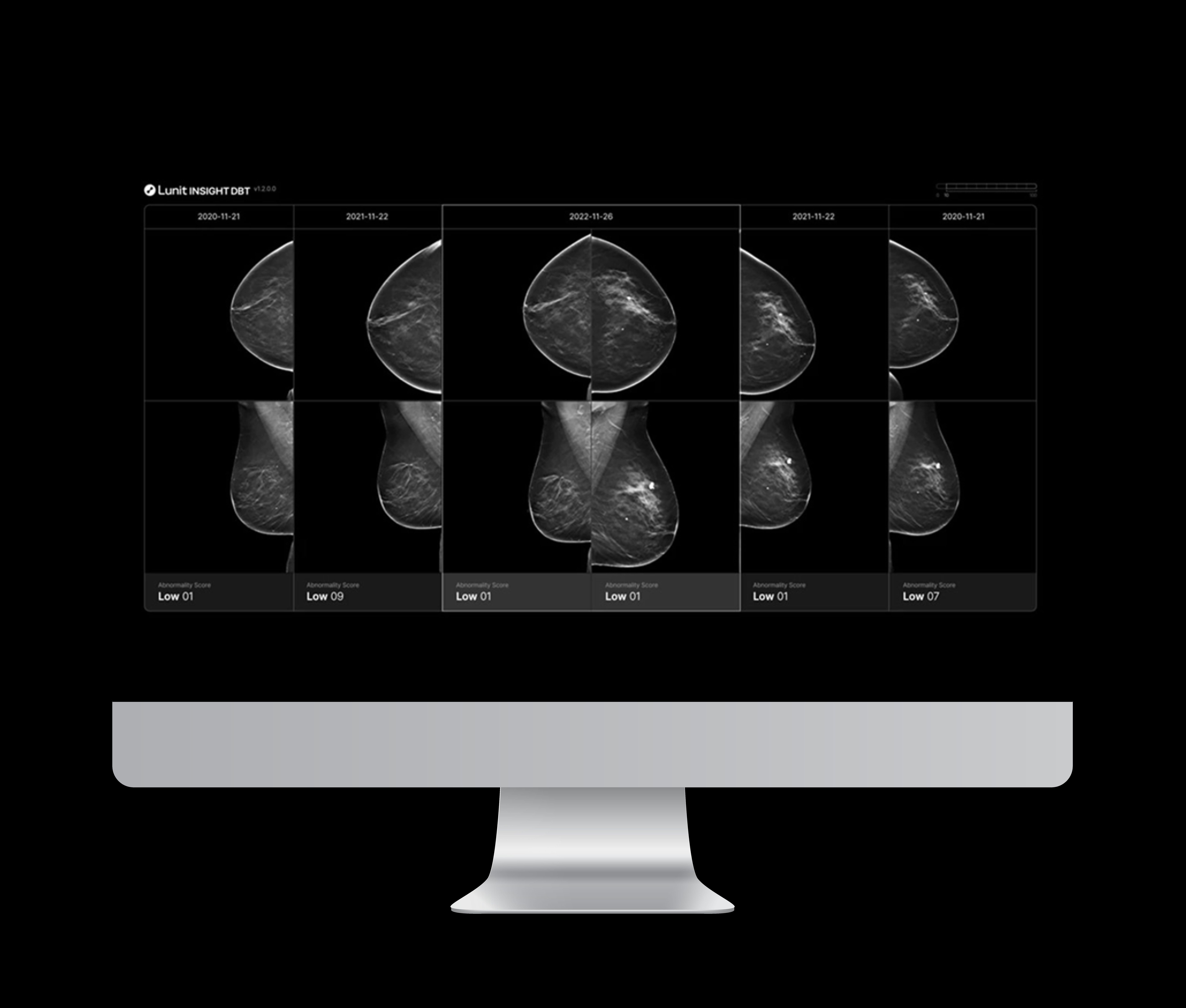 FDA Clears Updated Version of 3D Mammography Algorithm from Lunit