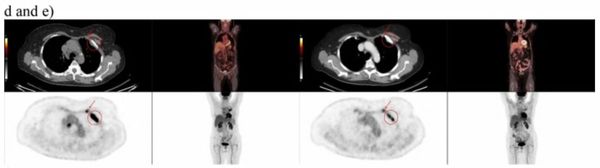 Study Suggests FDG-PET Better than CT for Assessing Treatment Response for Metastatic Breast Cancer