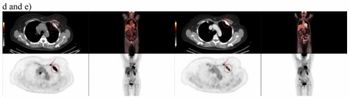 Study Suggests FDG-PET Better than CT for Assessing Treatment Response for Metastatic Breast Cancer