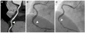 Coronary CT Angiography Study Shows Link Between Major Cardiovascular Events and High Lipid Core Burden