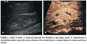 Microbubble agents helppinpoint renal lesions