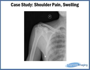 Shoulder Pain, Swelling