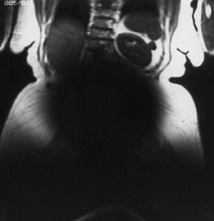 Conductive elements in implantable device degrade MR image quality