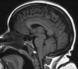 Image IQ: 52 y/o with Vertigo, Headache, Tinnitus