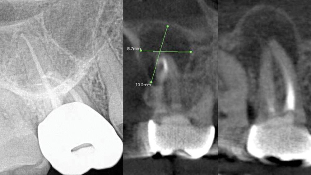 ndodontic cases can be challenging, especially those involving maxillary molars whose roots overlap into the sinus. CBCT imaging simplifies these cases, as the number of canals and the extent of pathology can be determined before initiating treatment