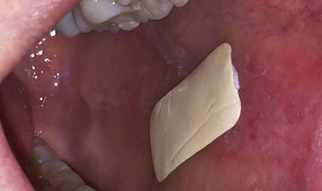 A Better Way To Treat Mouth Ulcers