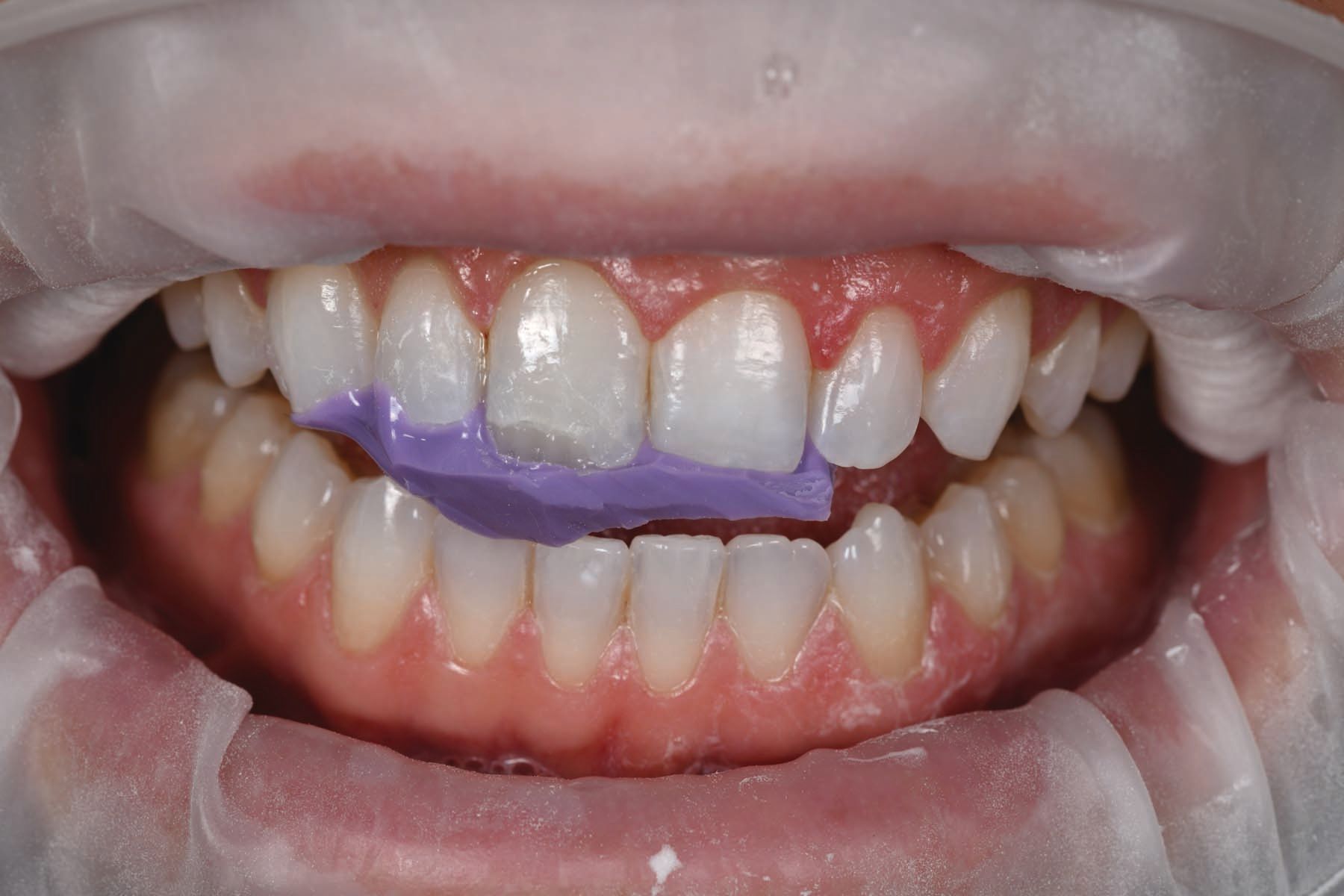 Figure 11. Subtle undulations along the incisal edge were created with a composite tool.