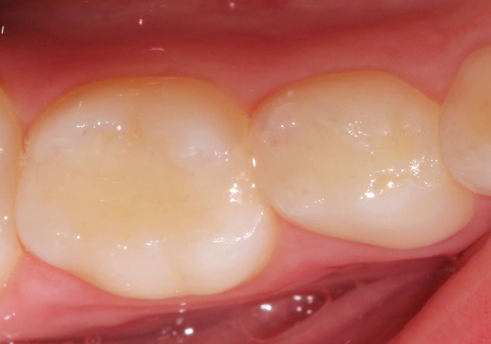 How to Use Composites That Stand the Test of Time for Pediatric Patients