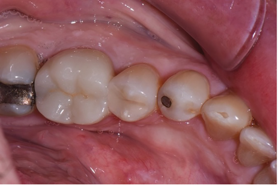 Figure 2 The postop view showing the single shade composite blending in with surrounding tooth structure.
