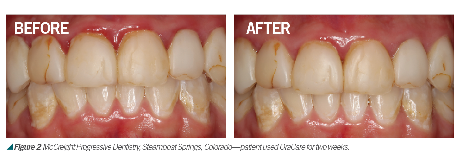 We May Be Headed Toward A New Mouthrinse Protocol We May Be Headed Toward A New Mouthrinse Protocol