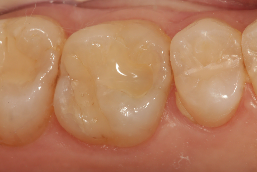 The final restoration completed with a bioactive restorative material which provides the same esthetic outcomes as traditional direct restoratives.