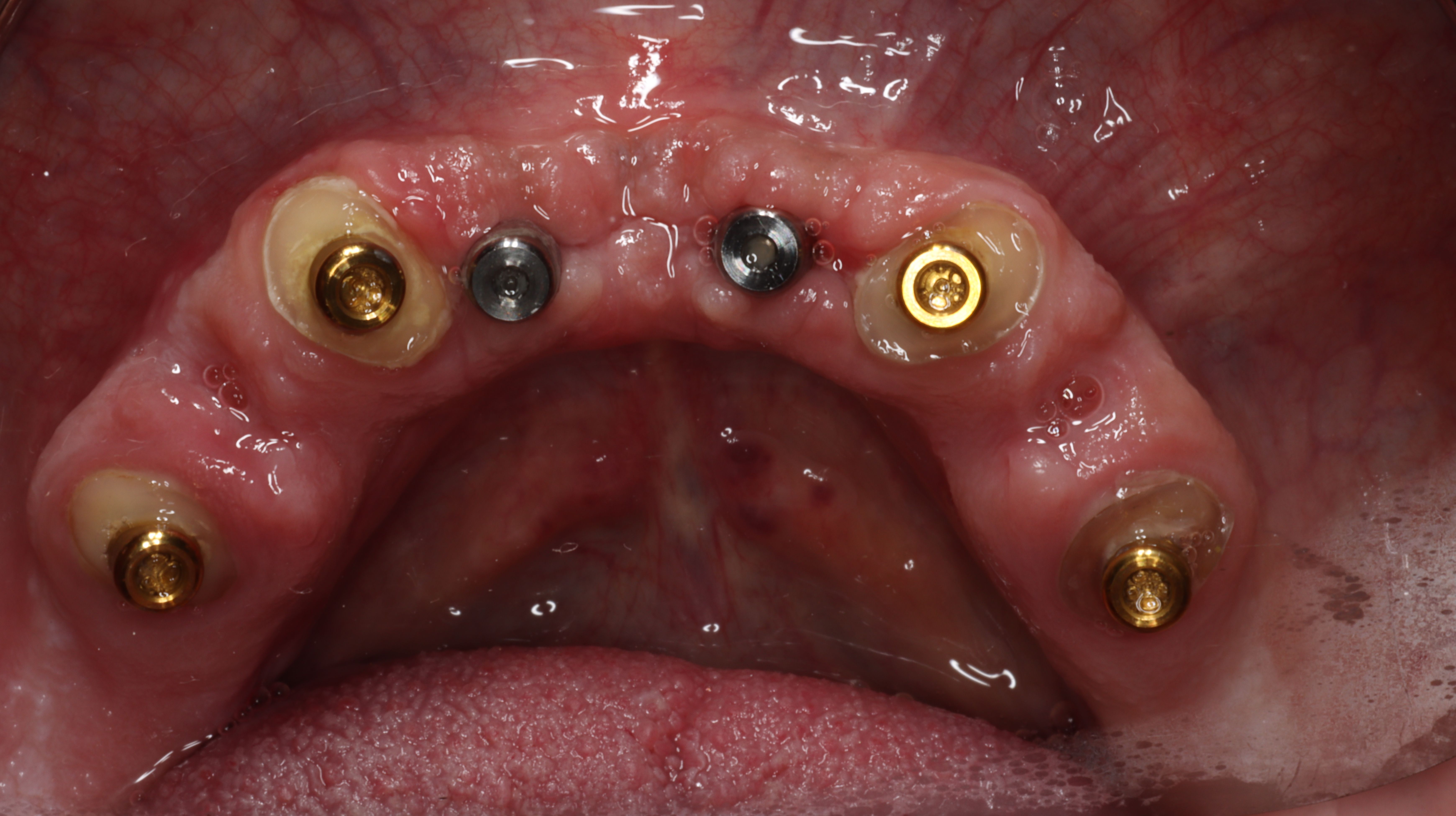 Figure 24. Two weeks post-op suture removal and adjustments of intaglio side of overdenture (Note the healed extraction sites and accelerated healing with PRP/PRF grafting biomaterials).