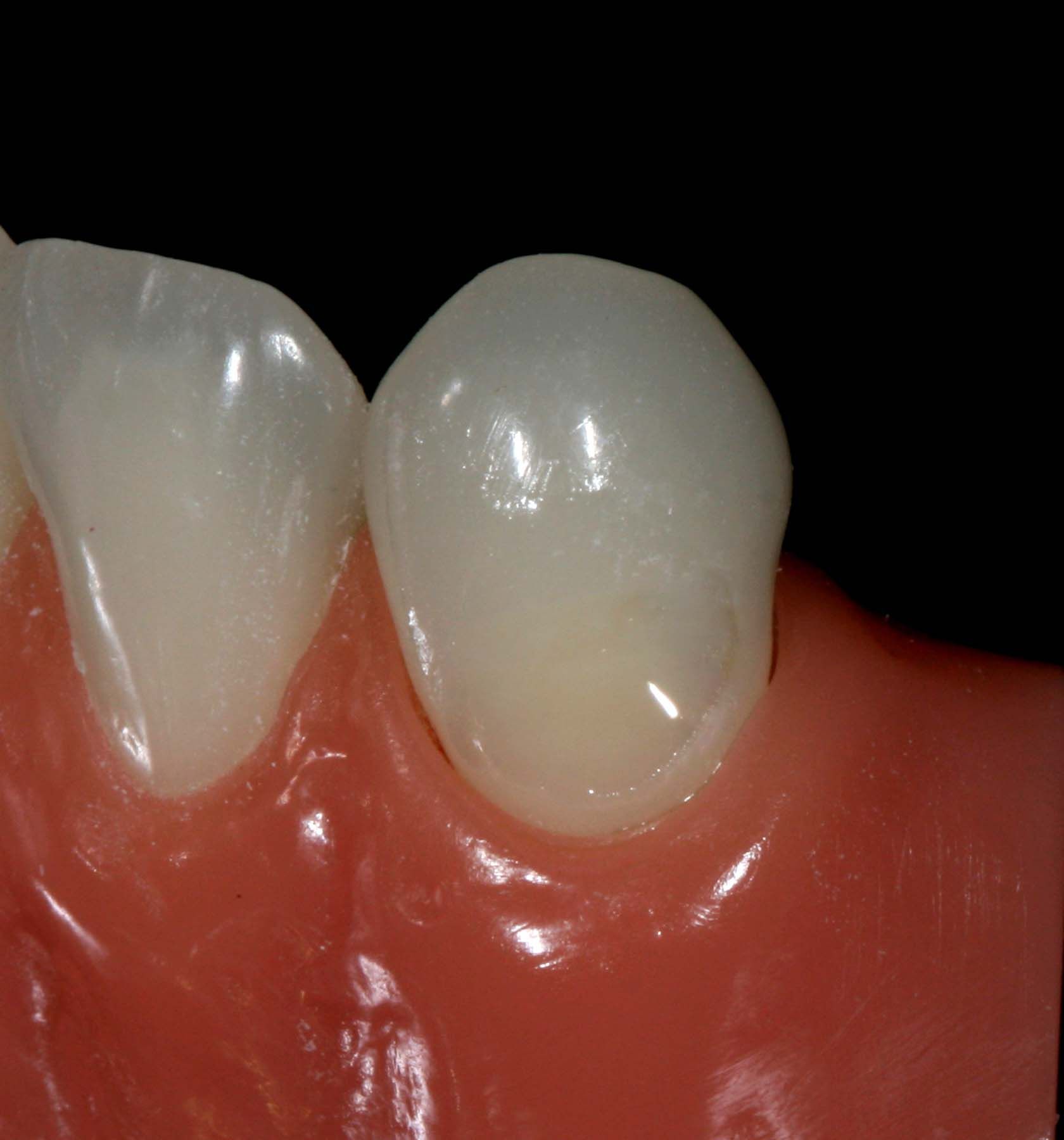 Figure 6. OMNICHROMA Flow placement on gingival margin light cured