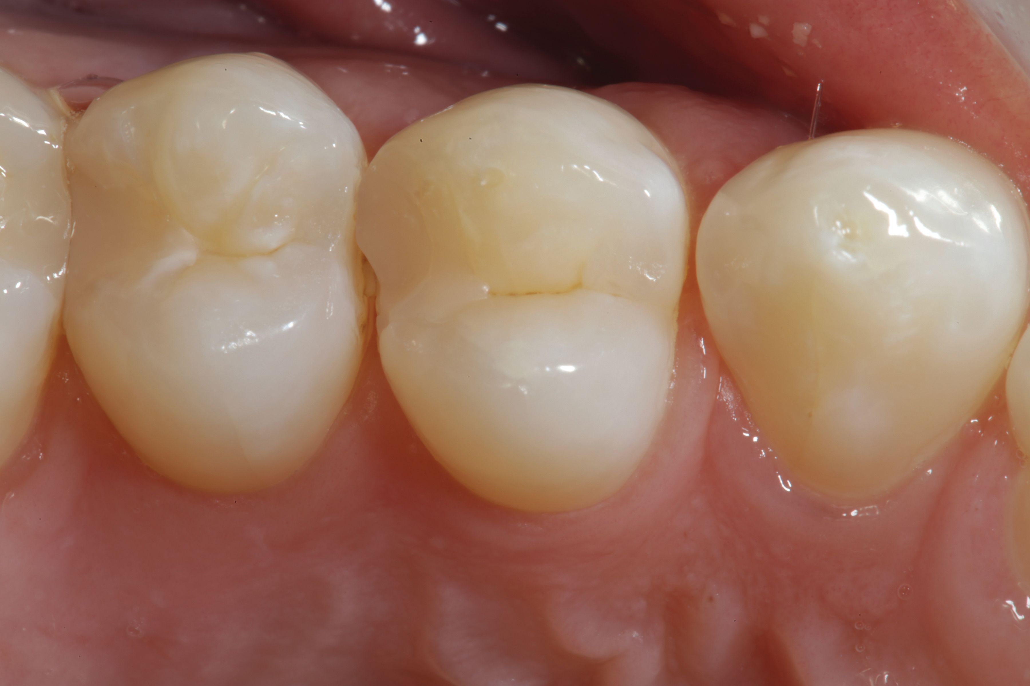 Composite For Marginal Ridge How to Bulk Fill Flowable Composite Restorations Without a Capping Layer