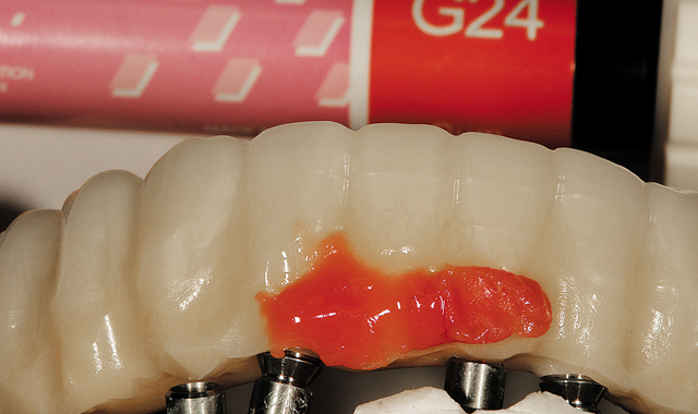 05 The author next applied ceramic composite, GC AmericaGradia #24 first, and then overlaid it with Gradia #23. The application was intended to imitate natural gum tissue for the patient in the mouth. The author next contoured and shaped the gum area. 