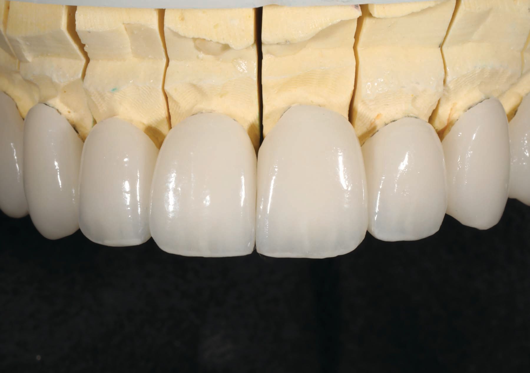 Figure 20. Glazed and polished IPS e.MAX restorations. 