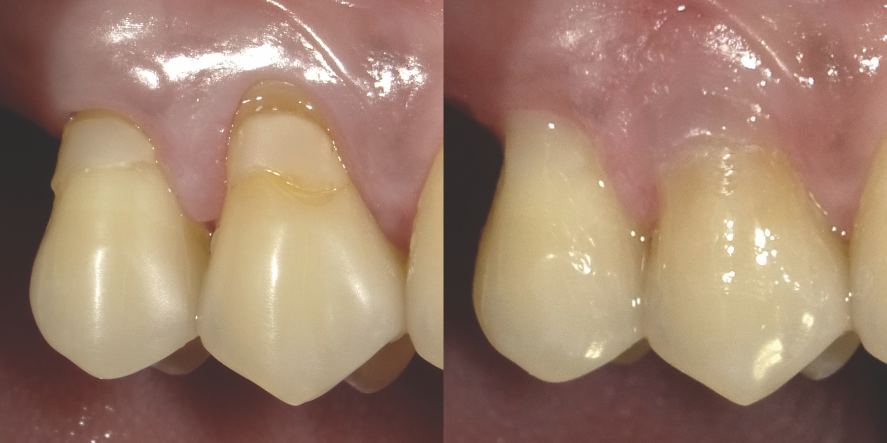 Beautifil II® Gingiva