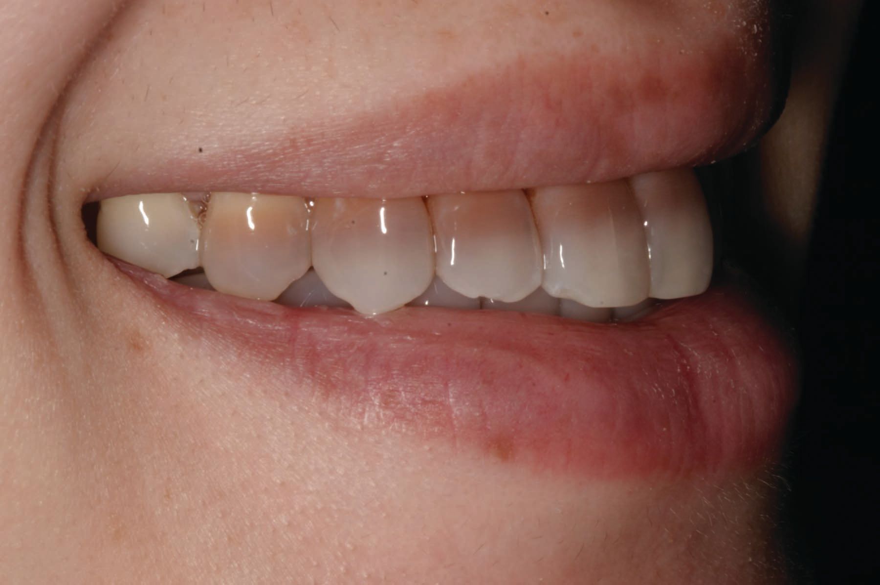 Figure 3. Preoperative 1:2 image of right lateral smile.