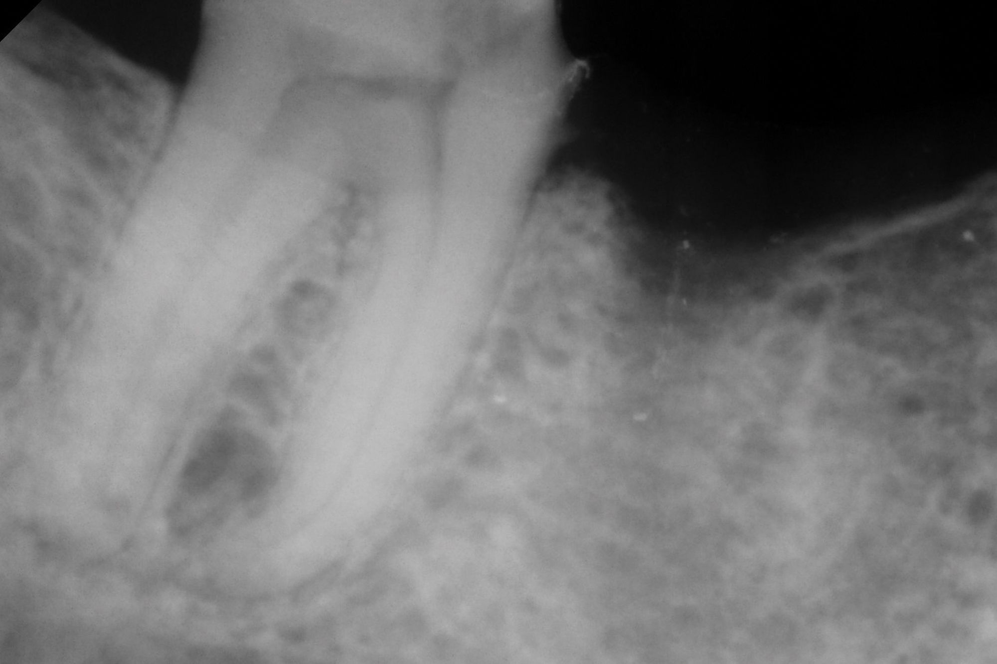 Vital Pulp Therapy in Mature Permanent Teeth: A Paradigm Shift