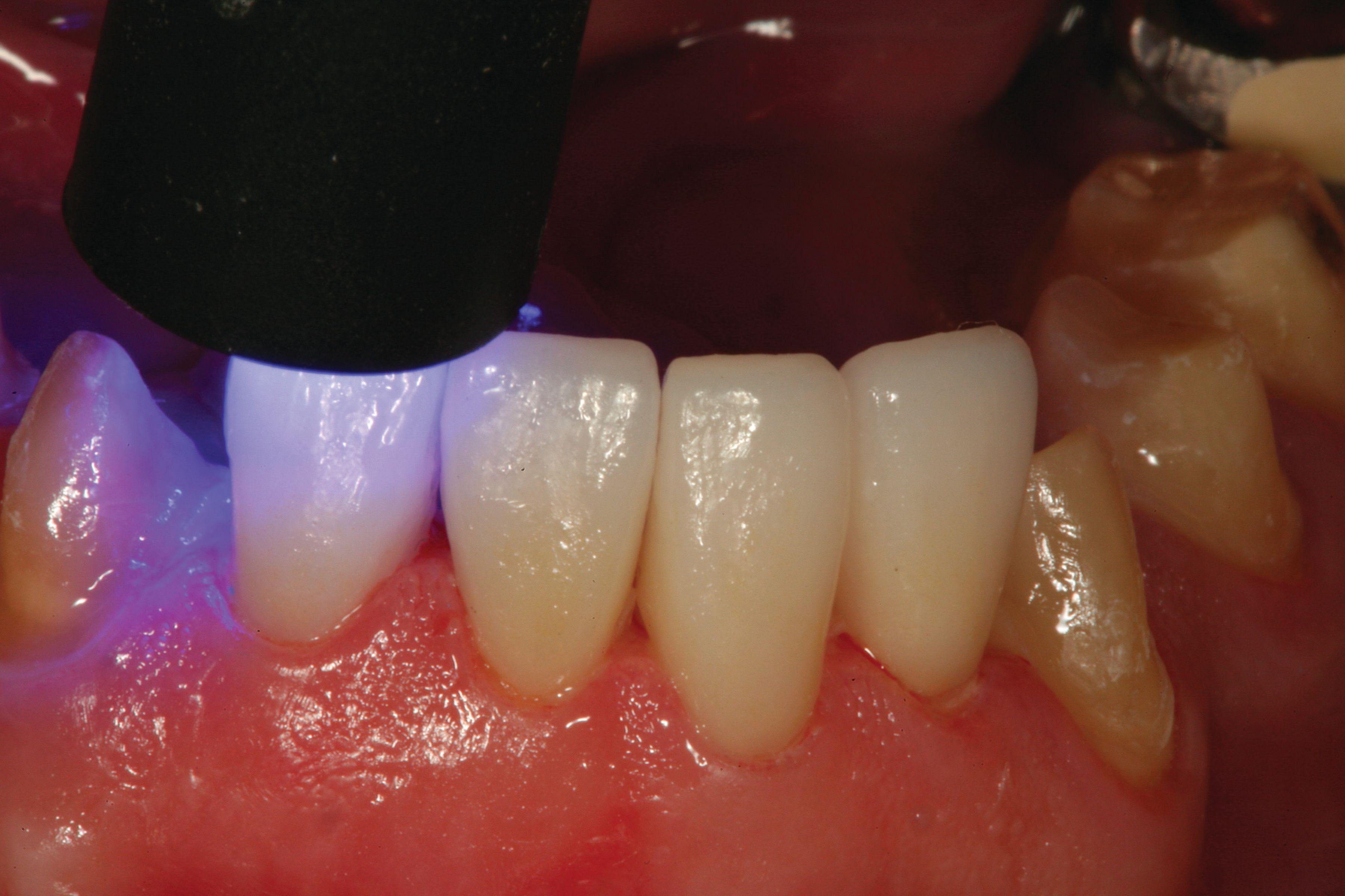 How to use the Universal Bond system for a perfect, predictable fit