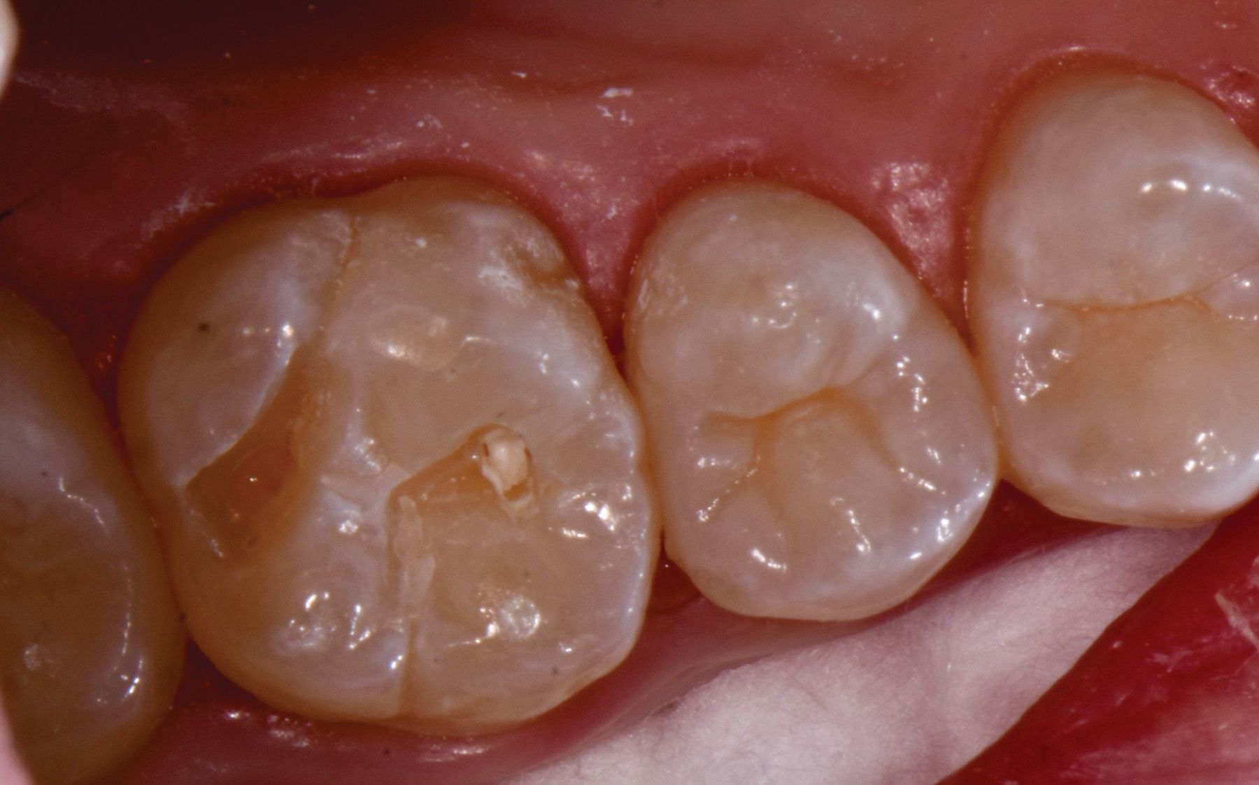 The Latest Trends in Dental Pulp Capping Materials - Figure 1