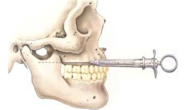 Vazirani-Akinosi Cloused Mouth Mandibular Block