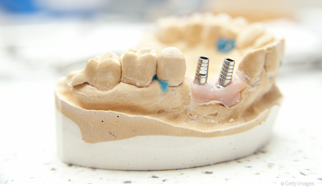 3 Reasons Why Tight Isn T Right For Dental Implants