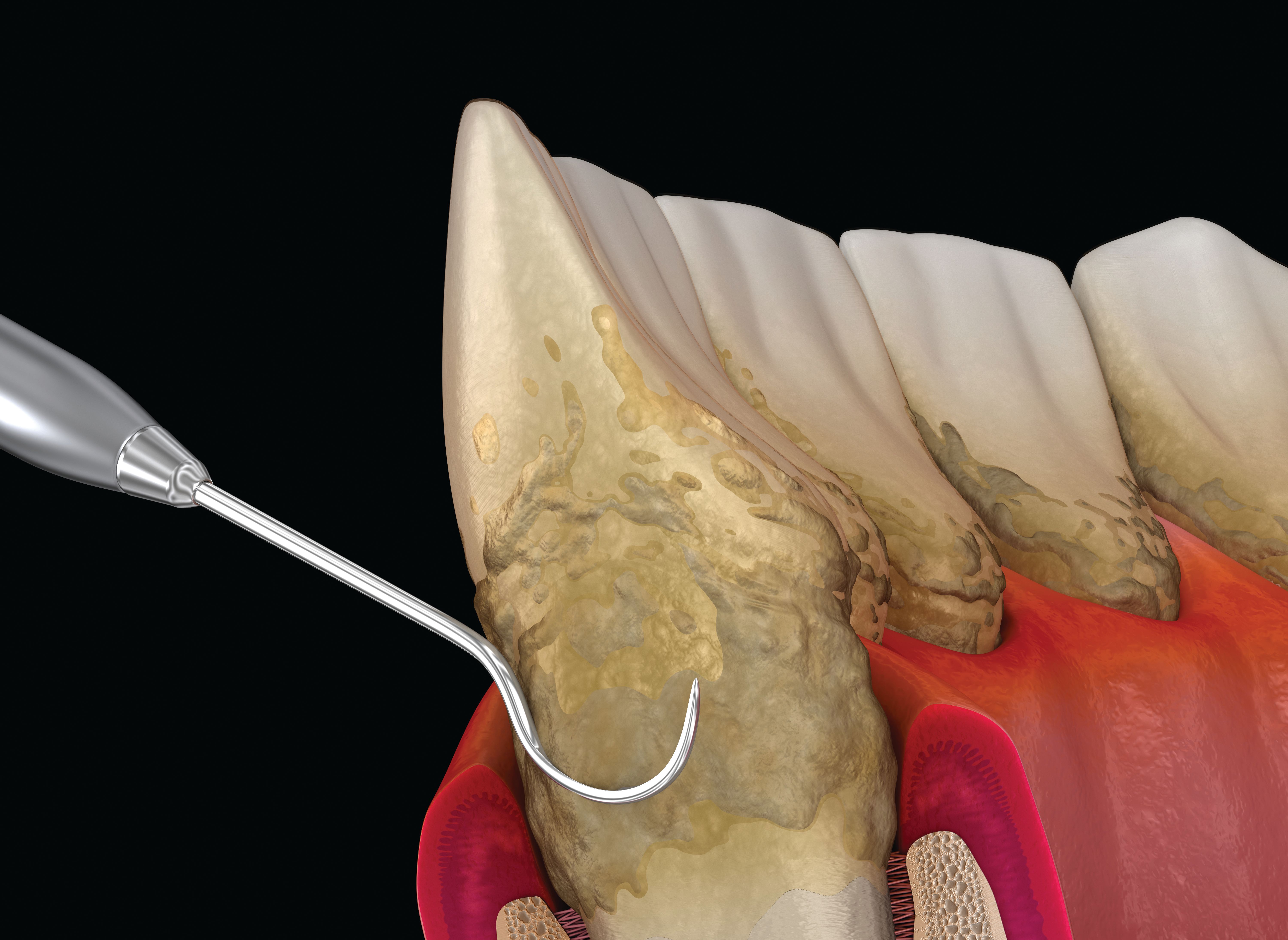 Periodontal Priorities: The Diagnostics and Treatment Changing Perio Care Periodontal Priorities: The Diagnostics and Treatment Changing Perio Care