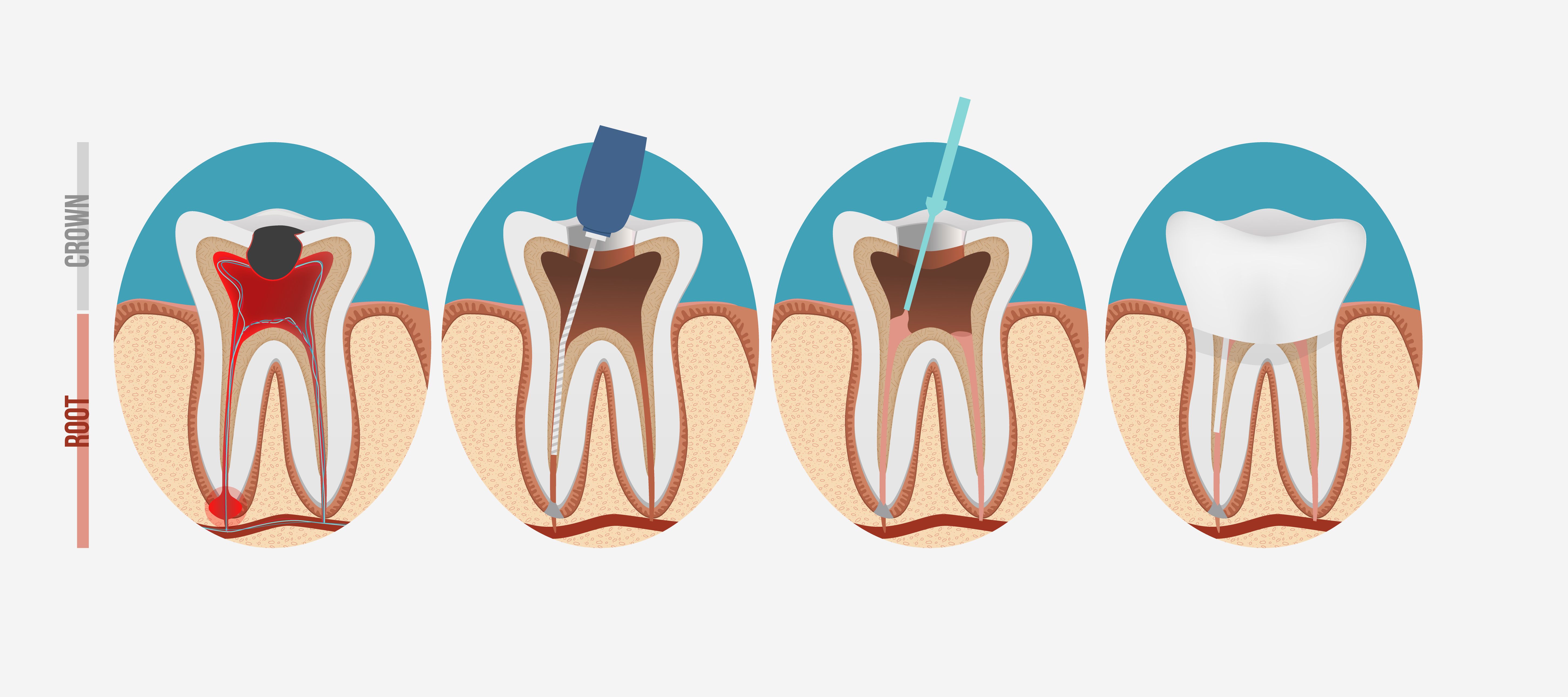 Сколько ходят с лекарством в зубе. 4 Канальный пульпит зуба. Многокорневой пульпит. Витальная экстирпация пульпы. Пульпита (депульпирование зуба.