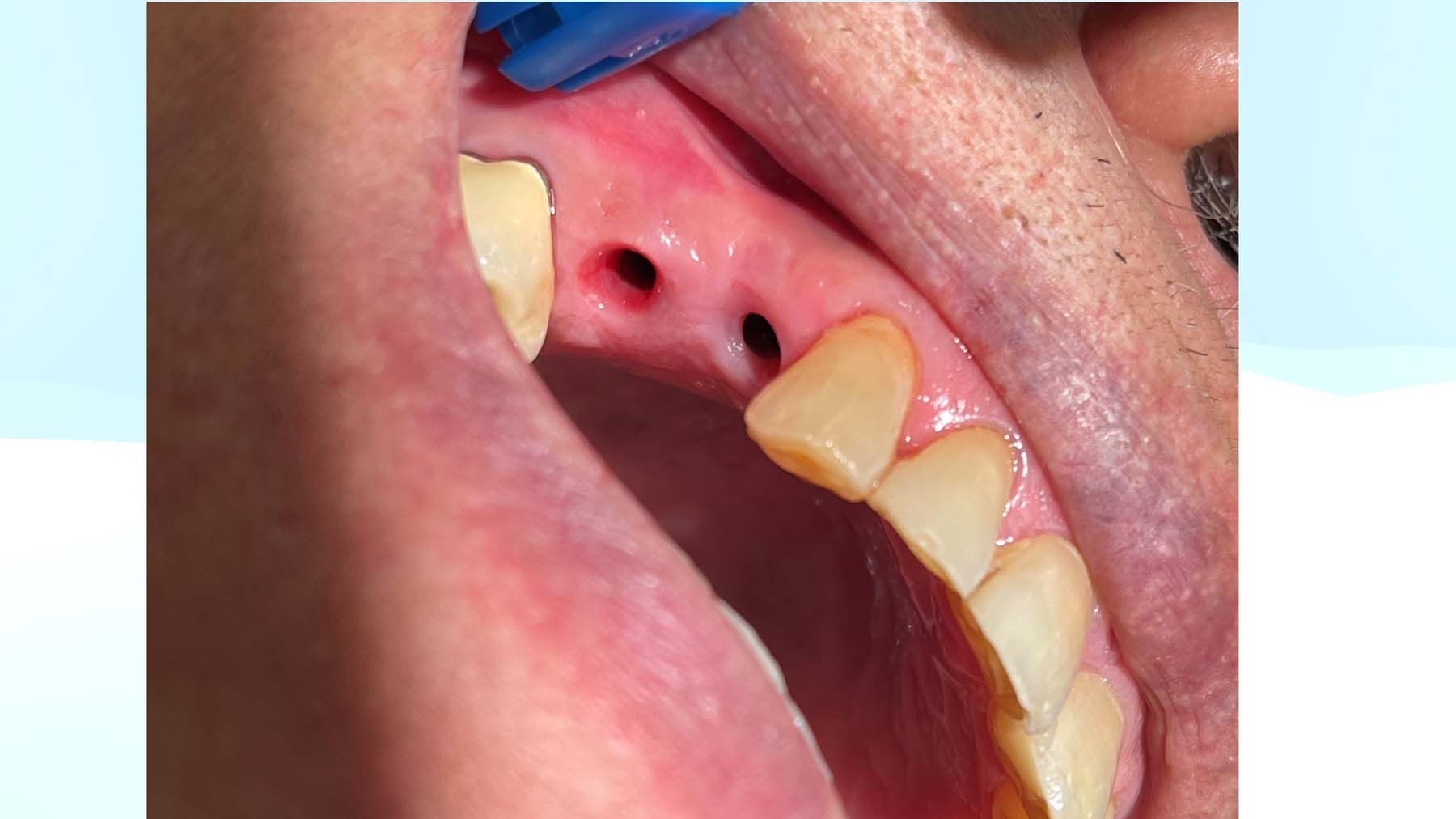 Figure 8. A view of the gingival emergence profile of the implant site #4 and #5. 
