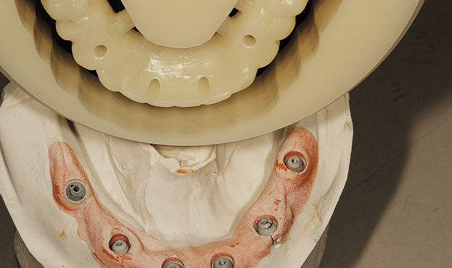 Step 3 The restoration is shown here on the model, created with PMMA, with implants in place.