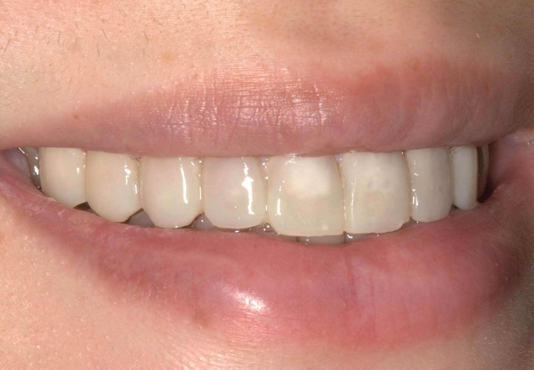 Figure 9. Provisional right lateral smile (note show-through).