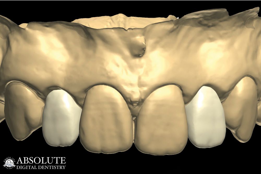 Conrad Fig.2 Digital design for Zirconia milling