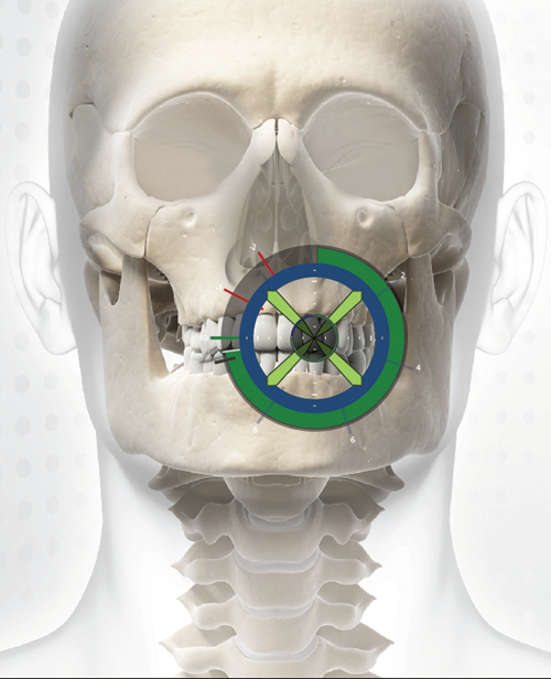 Applying The X Guide Dynamic 3d Navigation System In Your Practice Applying The X Guide Dynamic 3d Navigation System In Your Practice