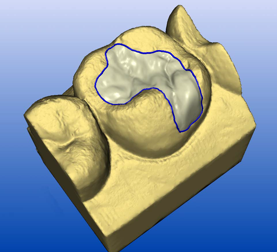 CEREC 3D design software